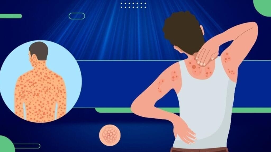 Psoriasis